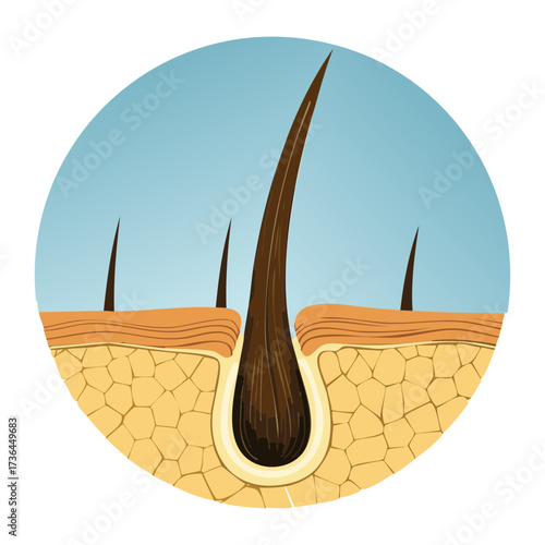 Educational medical diagram showing a cross-section of skin with a curled hair follicle and excessive sebum buildup