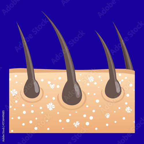 Medical illustration of multiple hair follicles with dandruff flakes and excess sebum causing scalp irritation and clogging