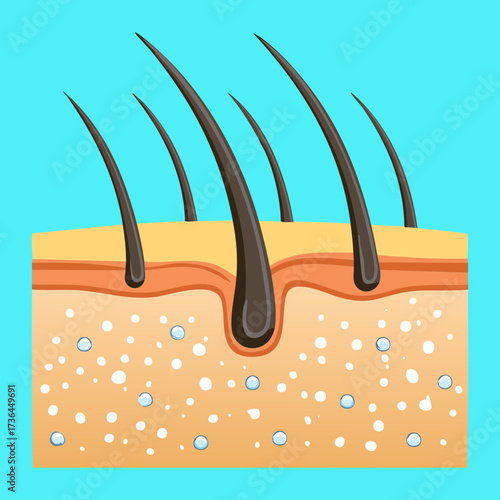 Diagram illustrating the cross-section of scalp skin with multiple hair follicles showing dandruff and sebum buildup clearly
