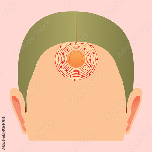 Rear view of a human head with a red inflamed and irritated area on the scalp possibly indicating an infection or sore
