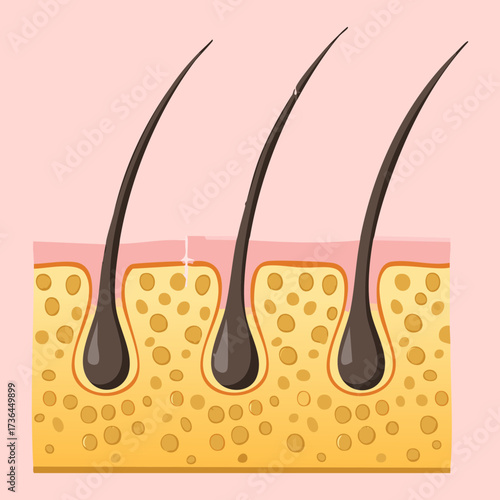  Simplified medical illustration showing the anatomy of hair follicles and roots in a layered cross-section of the skin