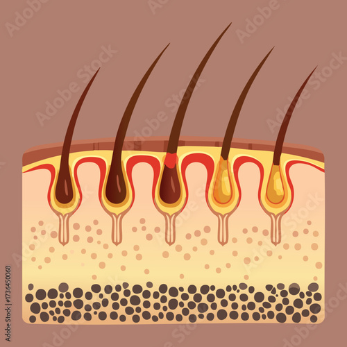 Cross-Section of Scalp Tissue Showing Hair Follicles Affected by Psoriasis or Severe Dandruff and Flaking Skin Cells	