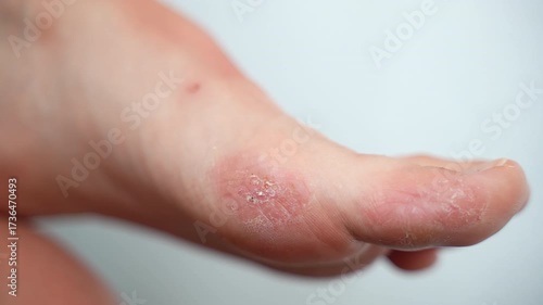 Patient's foot against white background with acute symptoms of dermatological disease, serious skin inflammation caused by chronic stress, moisture or allergy reaction, redness, dry skin, wounds and
