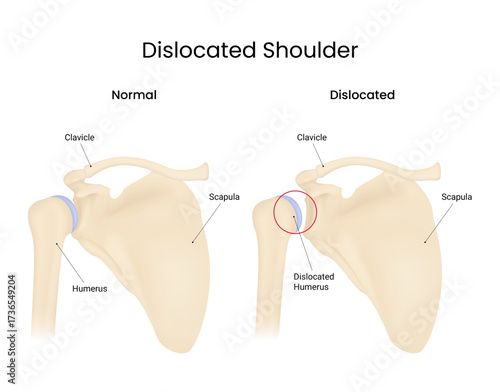 Dislocated Shoulder Anatomy Normal vs Dislocated Humerus Comparison