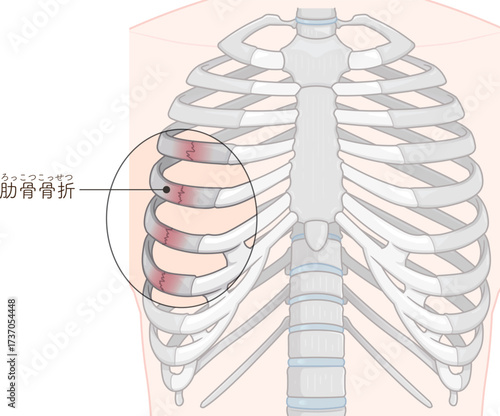 肋骨骨折のイラスト　Broken rib illustration