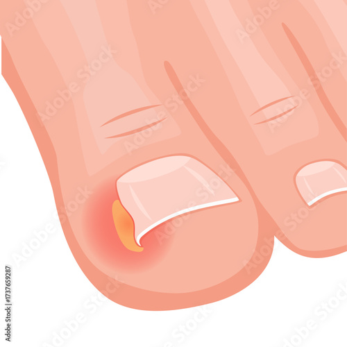 Ingrown Toenail close up on a white background