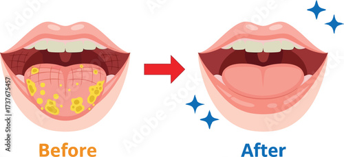 Tongue cleaning before and after oral hygiene dental care concept