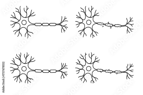 Comparison of healthy and damaged human neuron cells with intact and demyelinated myelin sheath