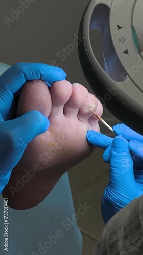 Foot care process performed on patient's foot with surgical instrument and gloved hands. Foot care to improve foot health performed by skilled professional for hygiene.