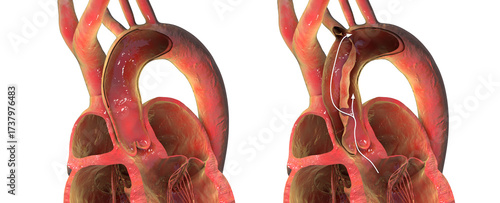 Photos Normal aorta compared with aortic dissection, 3D illustration