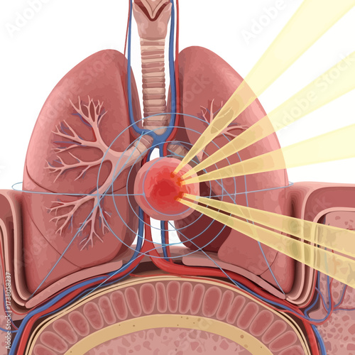Precision Radiation Therapy Targeting a Malignant Tumor