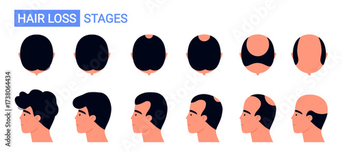 Male hair loss stages from full hair to baldness. Androgenetic alopecia and male pattern baldness progression chart. Isolated vector illustration in cartoon style