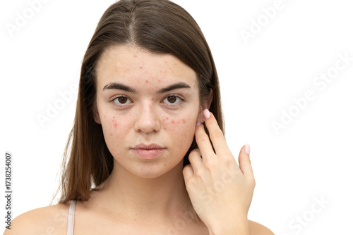 Portrait of young woman with acne on her face. Acne, skin care concept. Real photo.