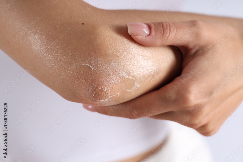 Naklejka premium Woman with dry skin on her elbow against light background, closeup