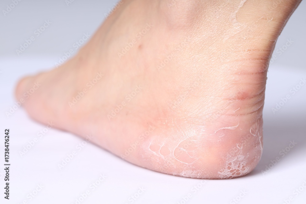 Fototapeta premium Woman with dry skin on her foot against light background, closeup