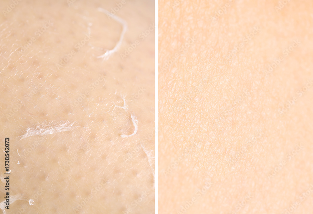 Fototapeta premium Dry skin on one side and moisturized on another, collage before and after