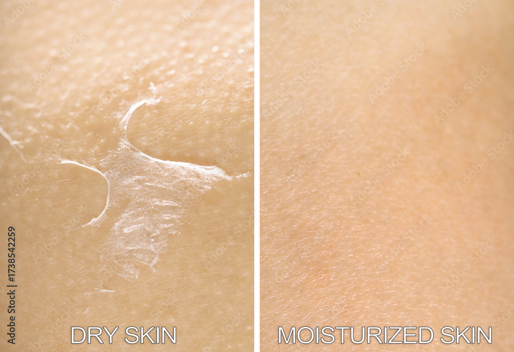 Fototapeta premium Dry skin on one side and moisturized on another, collage before and after
