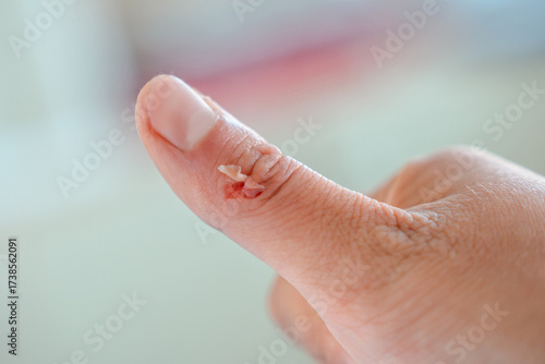 Foto Torn skin on the finger, wound and abrasion