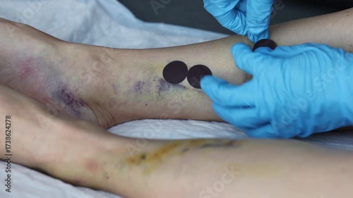 Doctor applies the stick on bandage to cover the small cuts after operation.