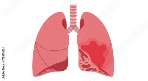 Detailed human lungs showcasing respiratory system health and potential disease indicators for medical education and awareness campaigns