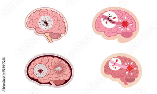 Human brain stroke medical anatomy vector illustration
