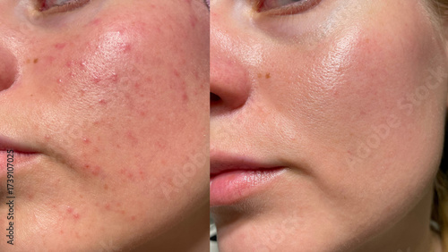 Close-up comparison of female cheek skin before and after care. Acne, redness, and blemishes reduced, showing clear and smooth result. Dermatology, skincare, beauty treatment.