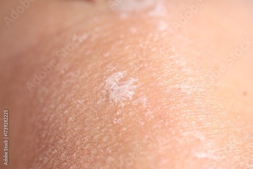 Closeup view of woman with dry skin