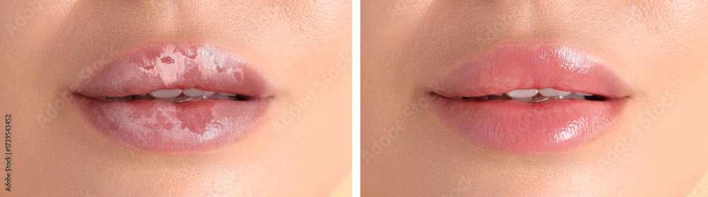 Obraz premium Lip care. Woman with chapped and dry skin before and healthy skin after moisturizing treatment, collage
