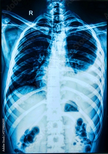X-image of chest showing Pleural Effusion. Pleural effusion x-ray.