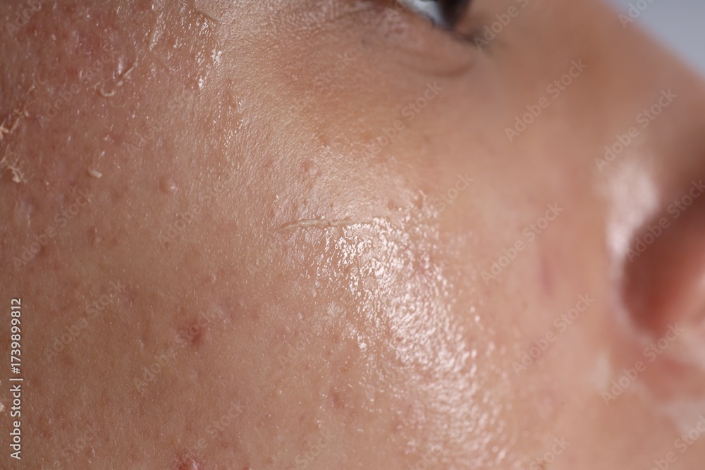 Fototapeta premium Woman with dry skin on her face, closeup