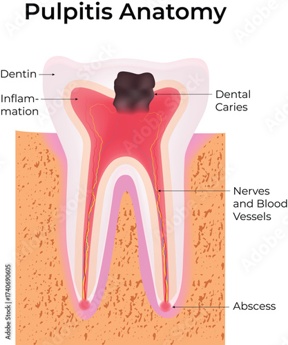 Pulpitis Anatomy Illustration Dental Caries Inflammation and Abscess Vector Illustration