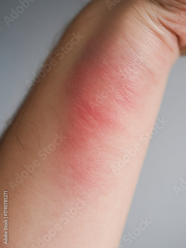 Close-up of Rash on Arm