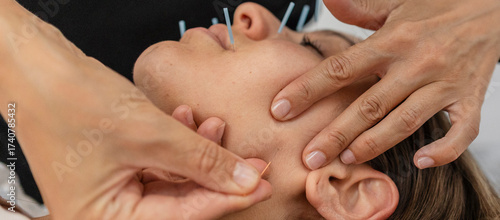 Obraz na plátně Woman receiving acupuncture treatment for facial skin therapy