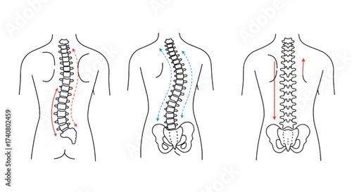 Scoliosis Spine Posture Anatomy Vector, Back Alignment Curvature Diagram Line Art
