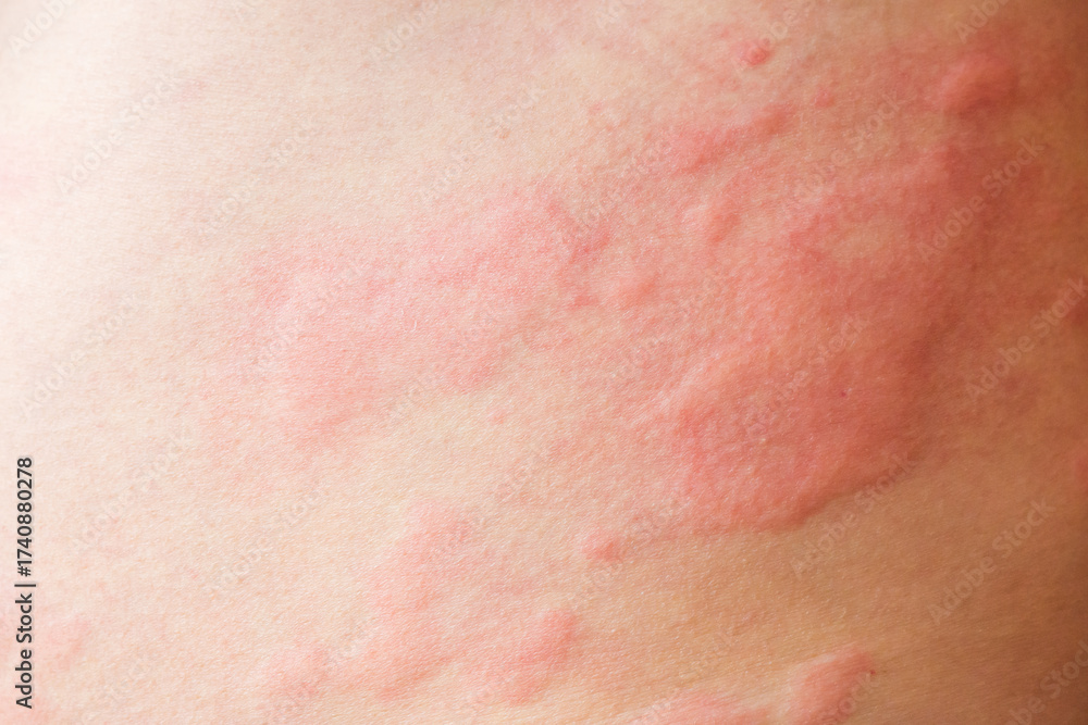 Fototapeta premium Skin allergy rash dermatitis texture close up background