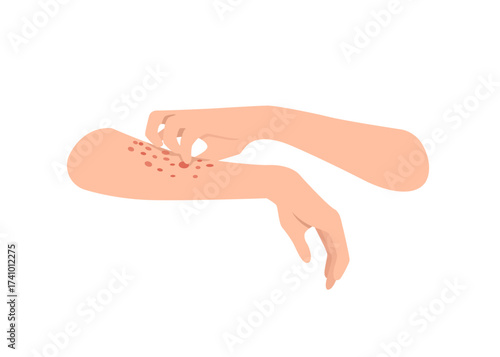 Illustration of hands scratching due to eczema