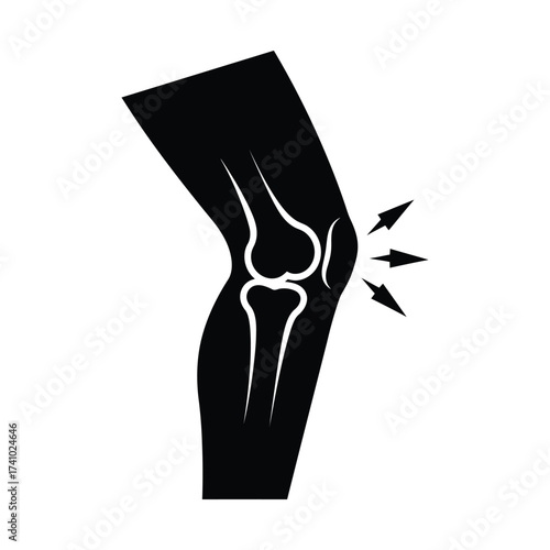 Illustration of a human knee joint with pain indicators shown clearly