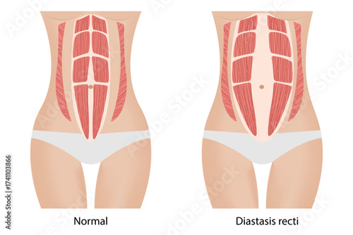 Diastasis recti. Separation of the muscles
