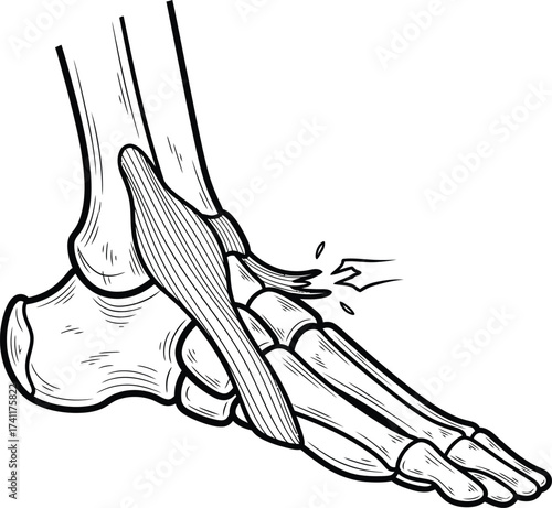 Ankle sprain with torn ligament medical drawing. Foot joint and tendon injury anatomical vector illustration.