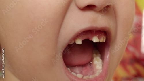 Child's hands pull out a wobbly milk tooth from the gumline