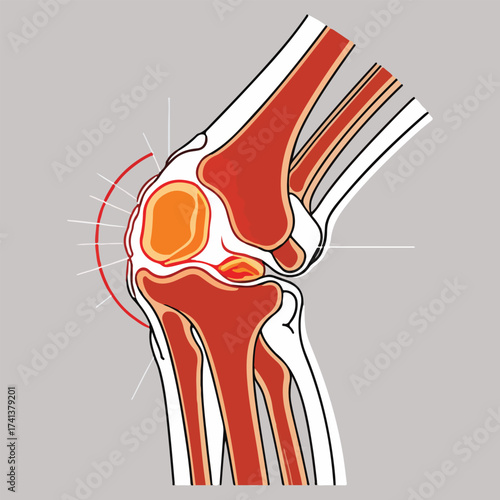 World Arthritis Day Awareness Vector Illustration with Joint Pain Highlights, Blue Ribbon, Flat Minimalist Design, Health Education and Arthritis Prevention Campaigns