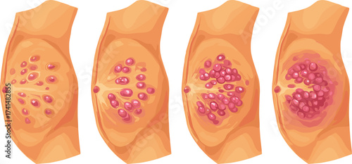 Breast cancer stages medical illustration, tumor growth vector diagram, human anatomy health awareness, oncology disease progression educational design for medicine and biology