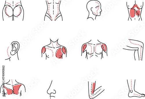 Plastic surgery anatomy illustration, cosmetic body diagram, liposuction treatment zones, aesthetic medical drawing, fat removal areas, healthcare vector, beauty clinic anatomy chart
