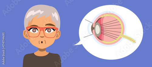 Medical cartoon showing an elderly woman with cataracts and a close-up eye diagram explaining with light distortion. Infographic detail for ophthalmology, healthcare and vision education materials