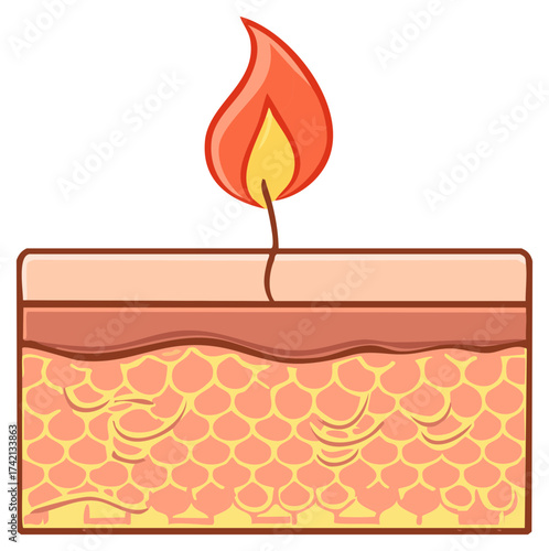 Human skin anatomical layers burning sensation inflammation pain heat damage medical illustration