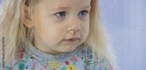 Slika na platnu Little girl with snot disease allergy. Selective focus