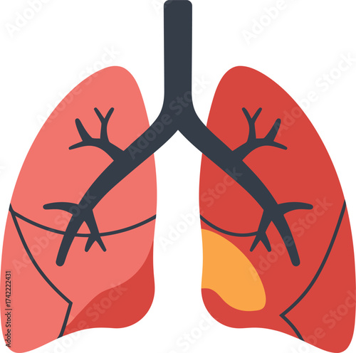 Anatomical human lungs with bronchi tree and a yellow spot indicating a medical condition isolated on transparent background