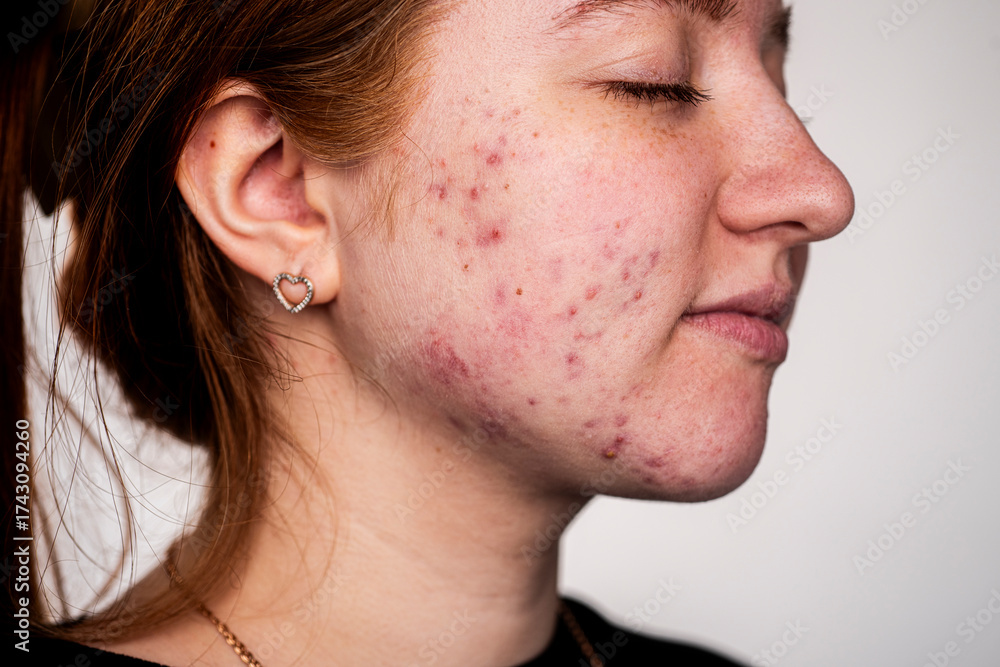 Obraz premium Skin texture background. Closeup acne pimple. Treatment for skin. Problem skincare. Pimples, acne, pores, scars. Natural skin. Skin care concept. Acne treatment. Pimples on face. Acne and pimple.