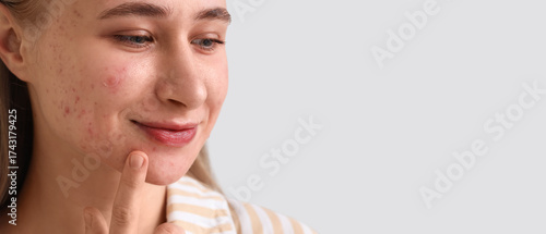 Fotografía Young woman with acne problem and applied pimple patches on light background, cl