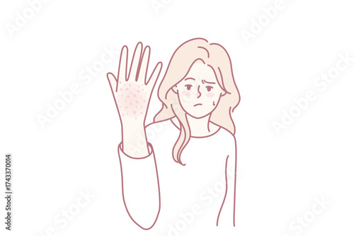 Unhappy woman suffer from redness on hand. Unwell girl struggle with psoriasis or seasonal allergy. Healthcare concept. Vector illustration.